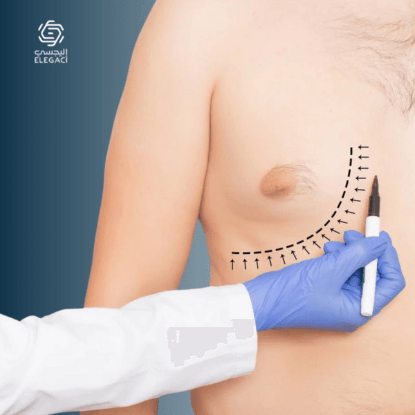 التثدي عند الرجال