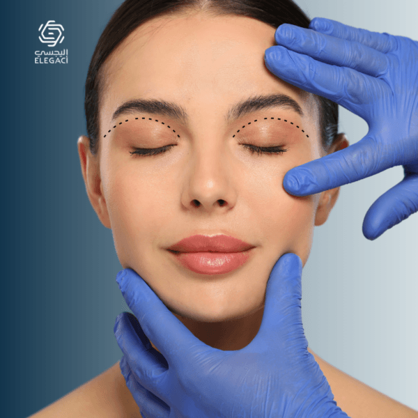 شد الجفون العلوية